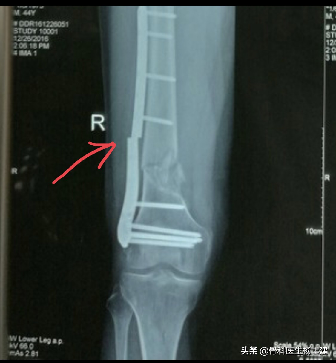 骨折手术后需要注意,什么情况下容易出现钢板断裂?