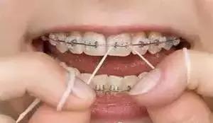 矫正牙齿是如何戴牙套的,矫正牙齿戴牙套需要注意事项