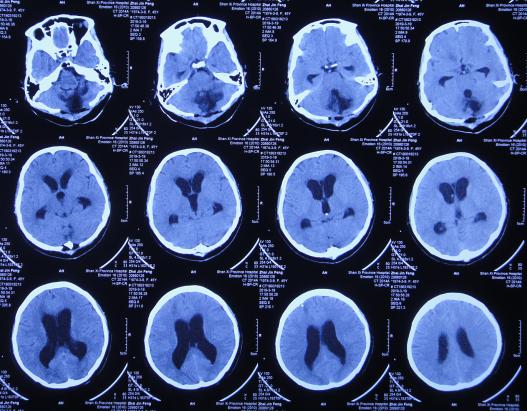 脑出血后脑积水会造成意识不清吗,脑出血后脑积水发高烧危险期多久