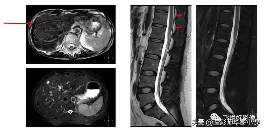 飞利浦磁共振独有技术,飞利浦磁共振减影技术