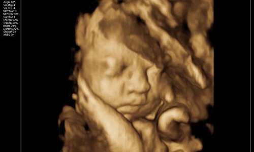 四维彩超显示胎儿一斤胎儿算胖吗,四维彩超胎儿怎么都长一个样