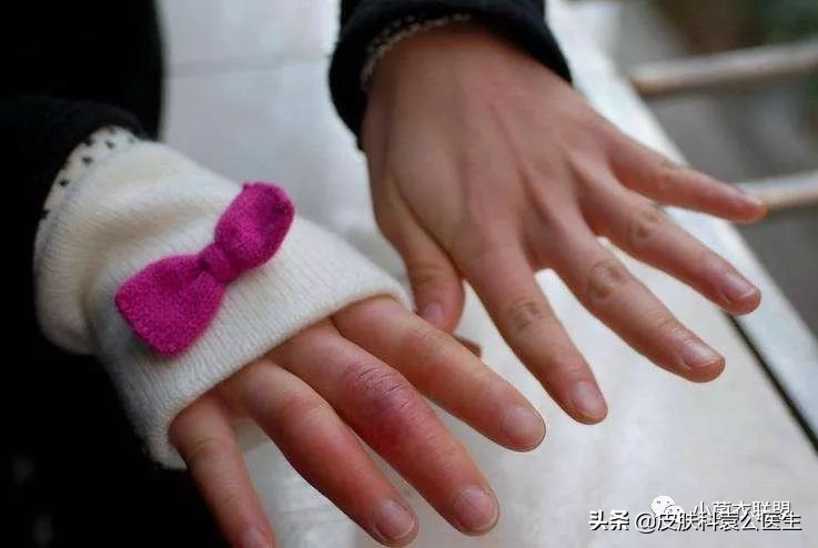 冻疮后期接触水干燥发痒怎么治,冻伤痒痛