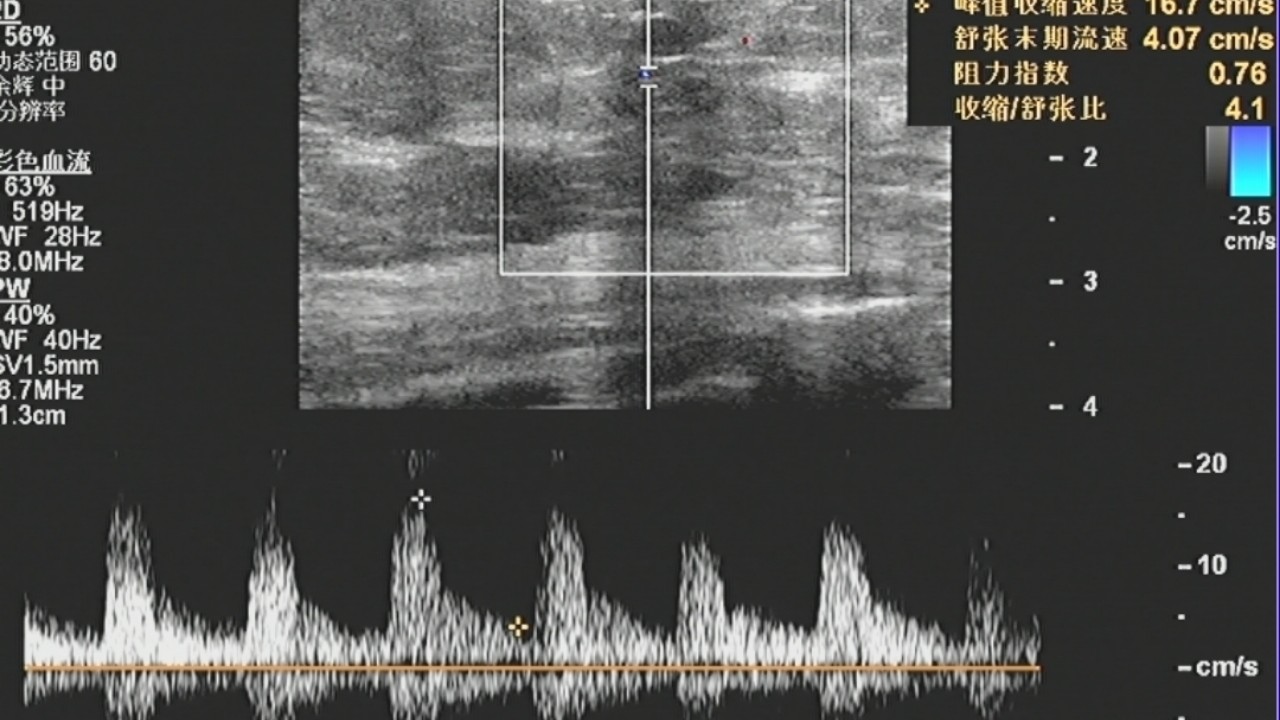 乳腺癌彩超能看出淋巴异常吗,乳腺结节和乳腺癌彩超区别