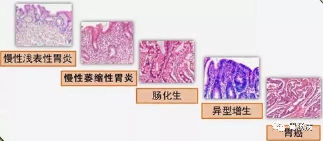 萎缩性胃炎与胃癌的关系,萎缩性胃炎与胃癌的症状区别