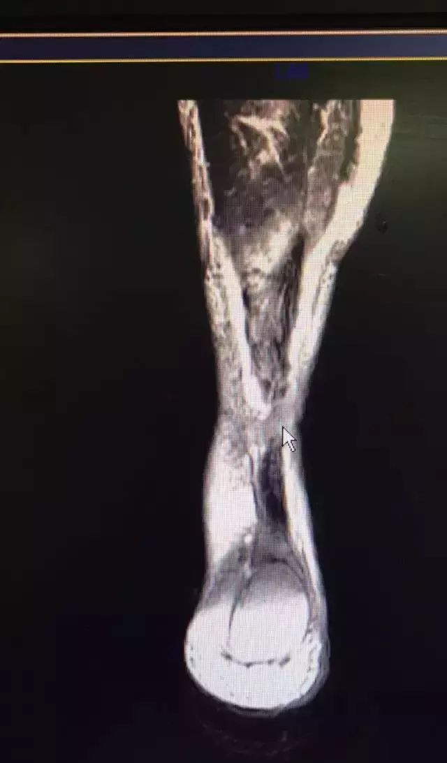 杜兰特对猛龙跟腱受伤视频,伤病猛于虎下一句