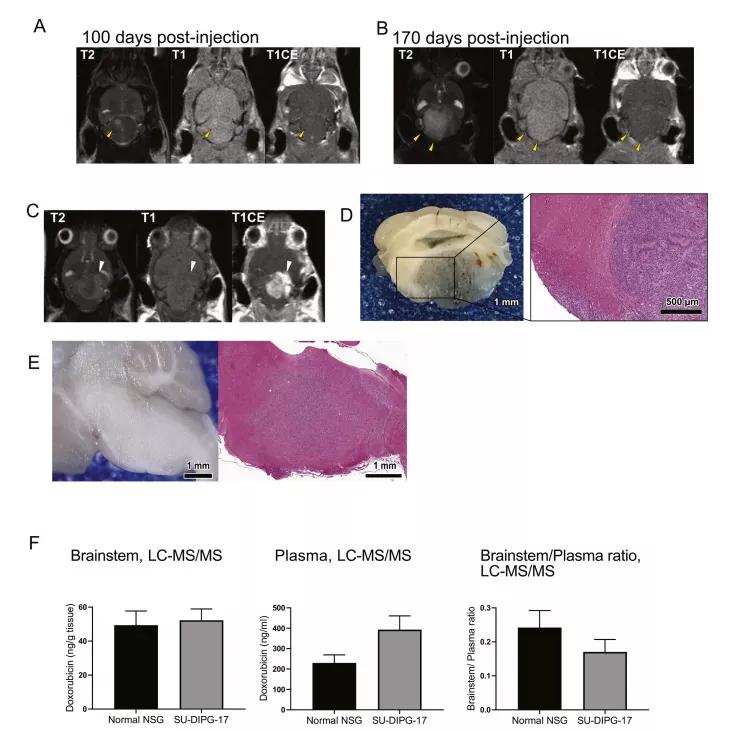 一级脑干胶质瘤,脑干胶质瘤指南
