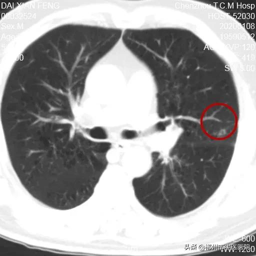 肺癌陀螺刀放疗后五年生存率,得了肺癌是不是不要轻易动手术