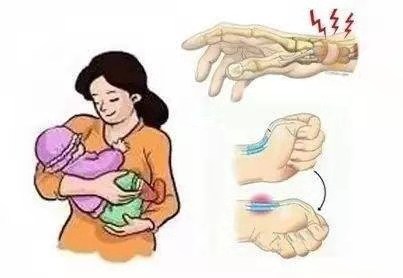 腱鞘炎已经不是妈妈们的专利，它正把魔爪伸向当代年轻人···