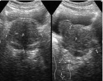 前列腺的检查哪种方法最好,男生前列腺检查痛苦