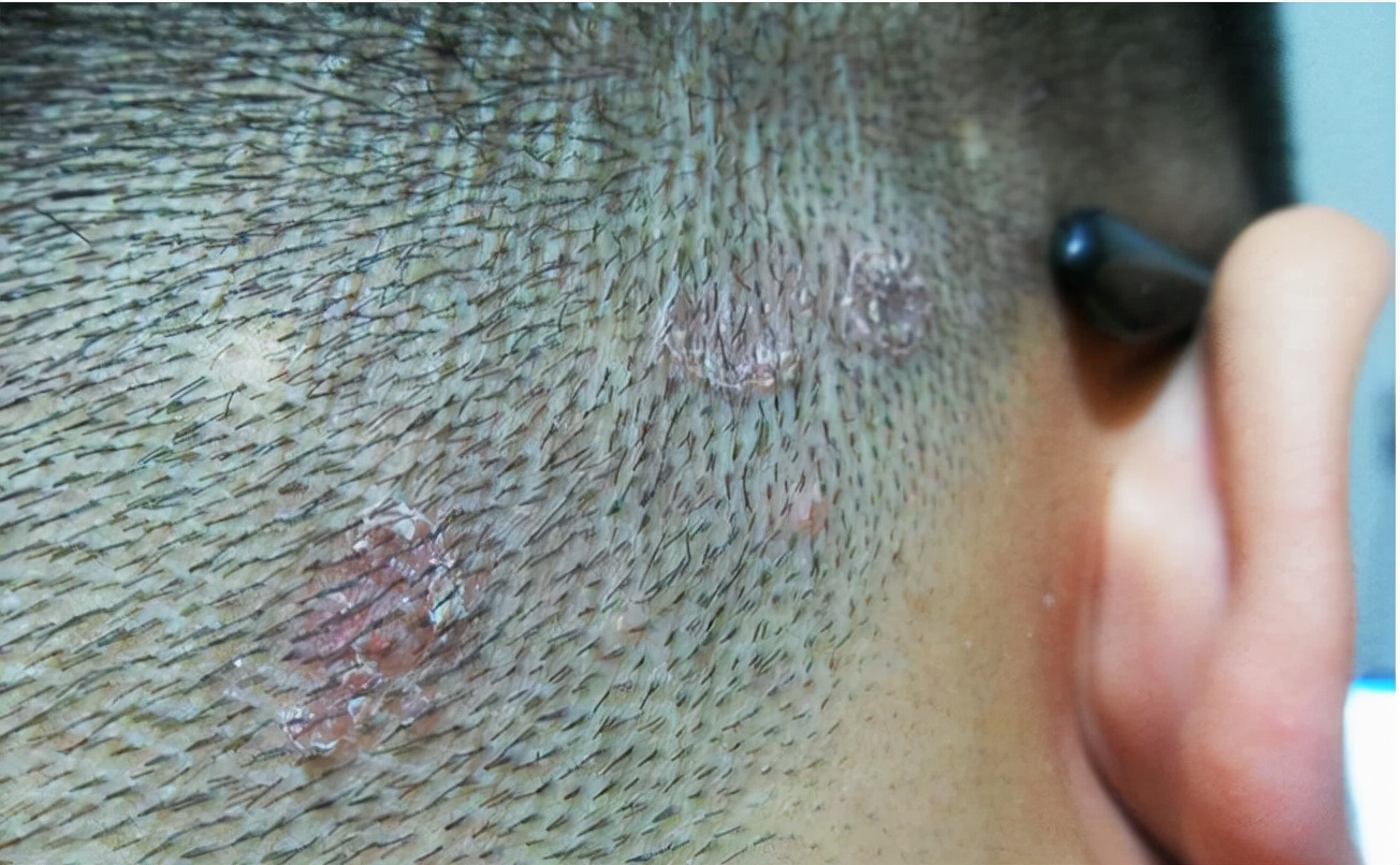 米诺地尔搽剂治疗脱发有副作用吗 (用米诺地尔所有人都会有副作用吗)