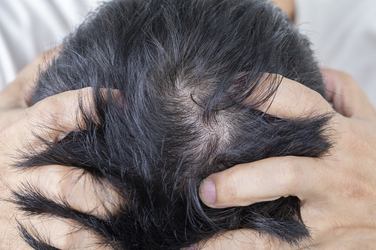 反反复复不好的“痘痘”，怎么回事？要注意，有可能是毛囊炎