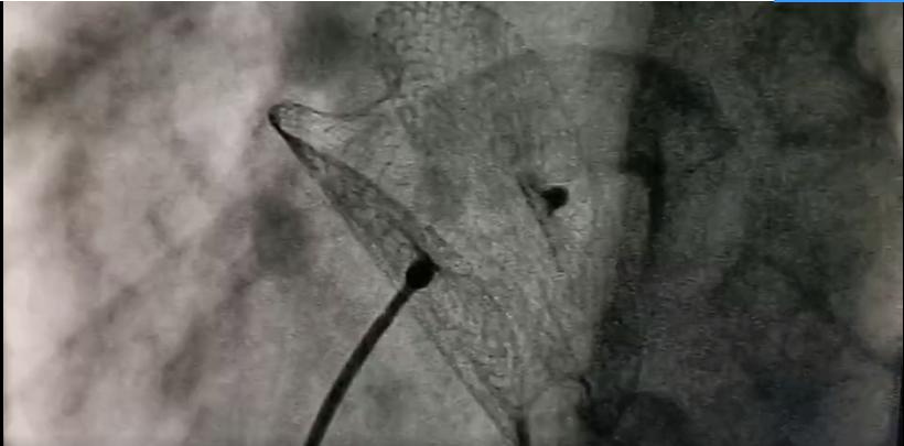 先天性心脏病手术协和医院免费,不用开胸的心脏手术