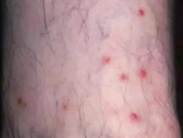 尘螨叮咬怎么治疗,螨虫叮咬传播疾病