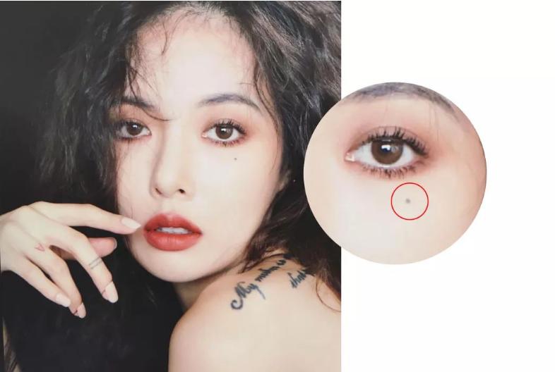 祛痣笔祛痣后留了疤怎么办,祛痣会留疤坑吗