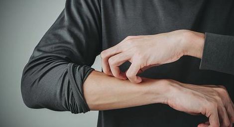 湿疹问题在哪里,湿疹症状健康科普