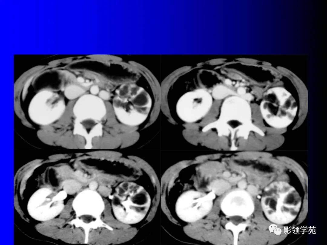 肾脏囊性肿块的影像学特点,肾脏典型病理图片及解析