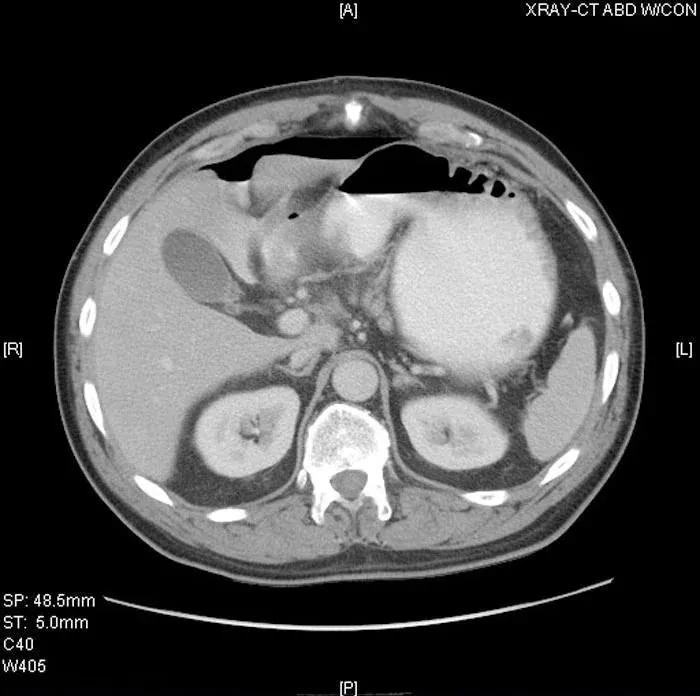 「病例挑战」男子每日饮酒，因胀气伴剧烈背痛入院治疗，咋回事？