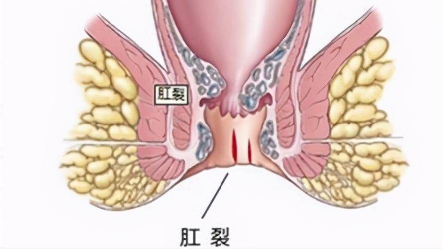 怎么快速解决便秘造成的肛裂,便秘引起肛裂怎么治疗好