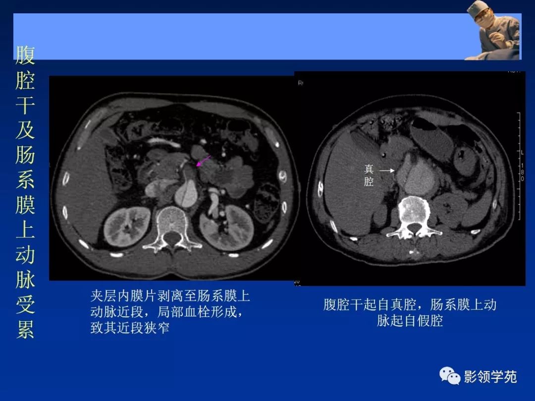 主动脉夹层壁间血肿如何鉴别,主动脉夹层血肿溃疡