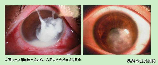 眼睛被飞虫撞红肿怎么办,虫子飞进眼睛角膜肿了严重吗