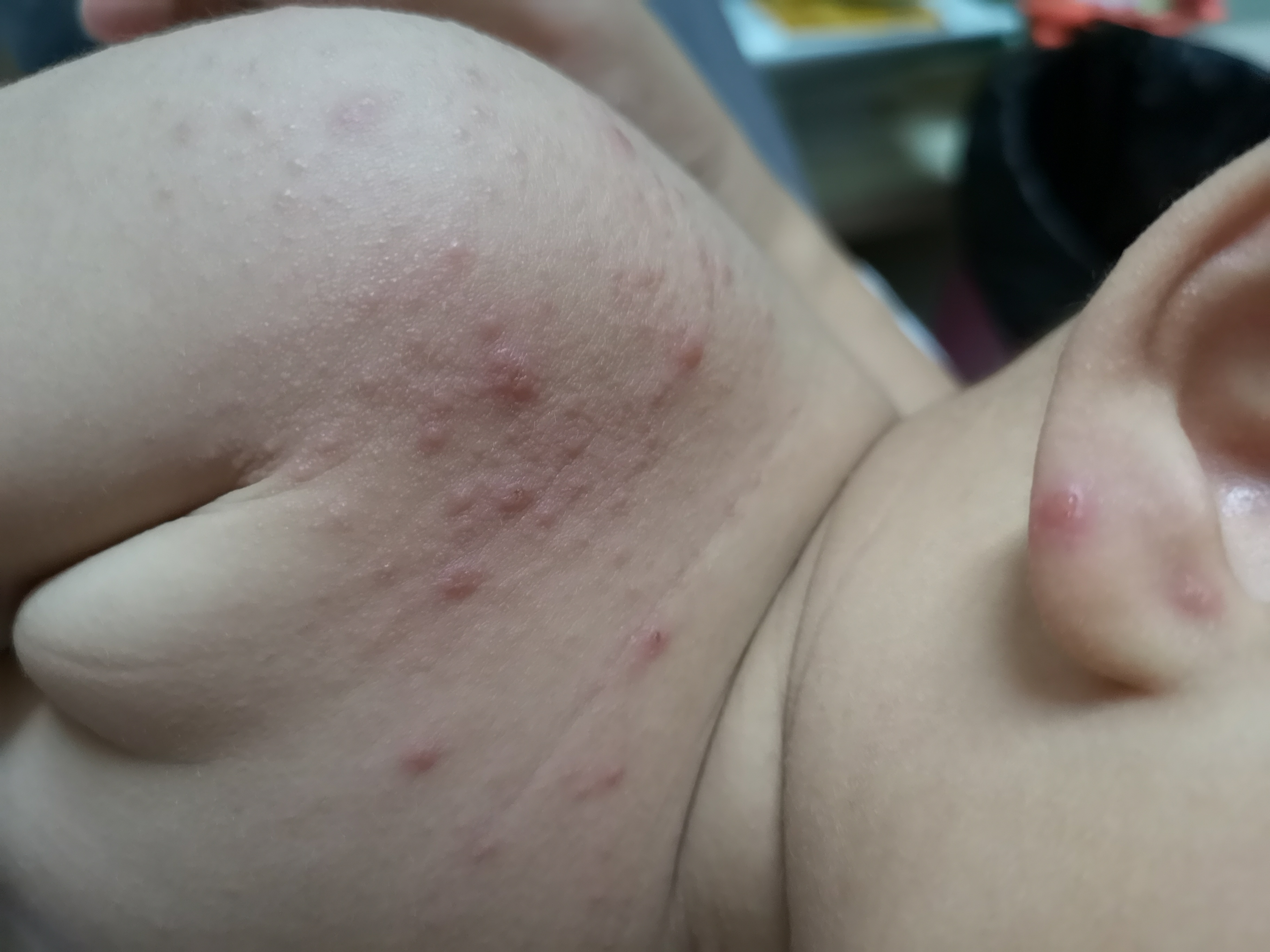 手足口病毒高发期,手足口高发期温馨提示