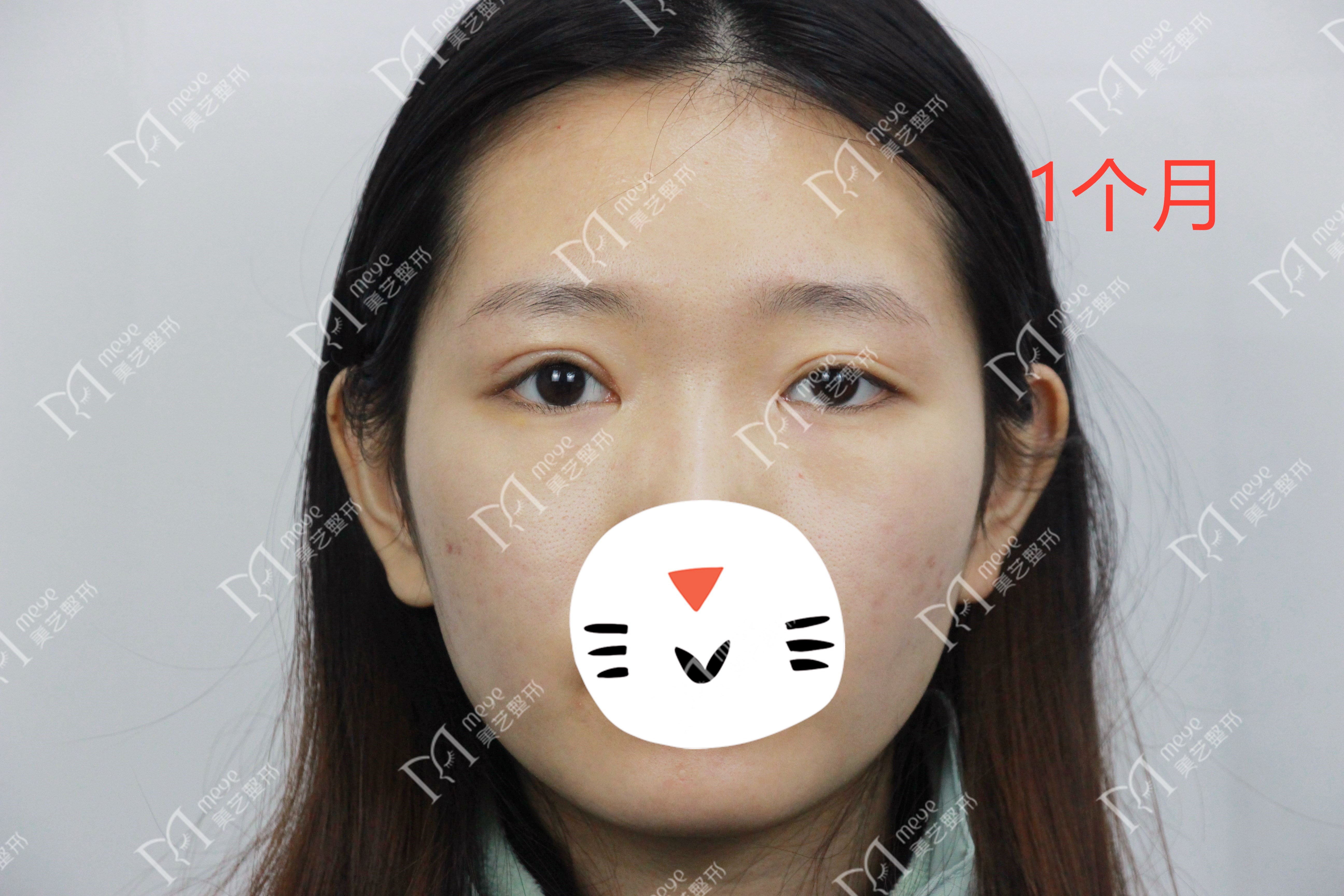 单眼上睑下垂修复术,上睑下垂眼睛修复手术成功率高吗