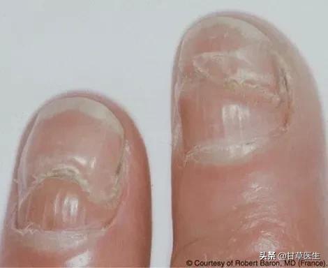指甲出现这几种变化可能是肿瘤,心血管疾病指甲有变化吗