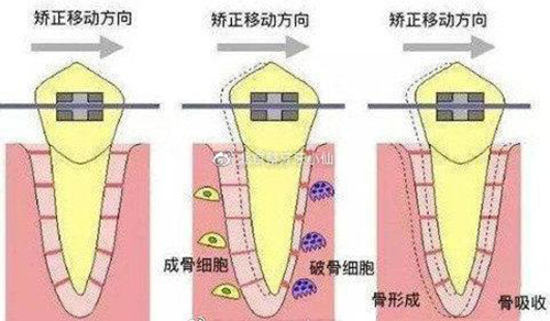牙齿矫正会导致脸塌吗,牙齿矫正会使牙齿脱落是不是谣言