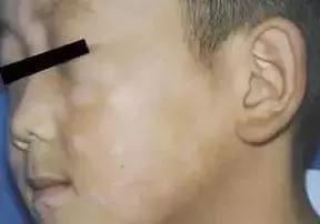 宝宝脸上长白斑可以打预防针吗,宝宝脸上有白斑吃打虫药好吗