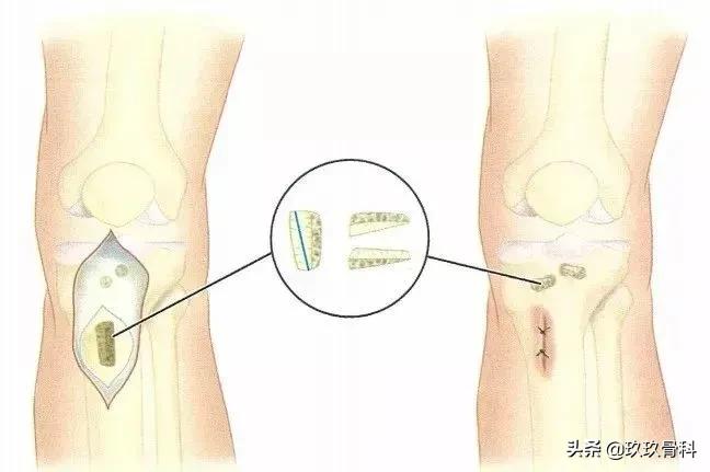 青少年膝盖疼骨骺炎怎么缓解,胫骨结节骨软骨炎怎么缓解疼痛