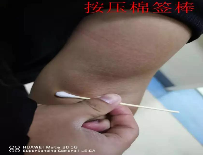 抽血完怎么不留淤青,抽血后如何按压止血