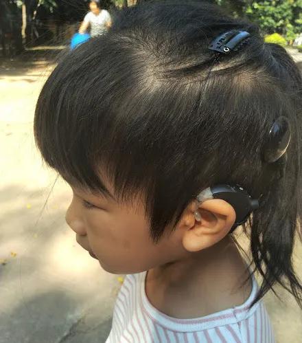 人工耳蜗的选择,怎么选择适合自己的的人工耳蜗