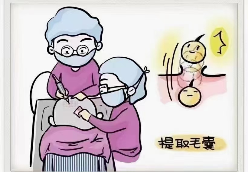 大家谈谈植发的经历,植发真的是一个漫长的过程