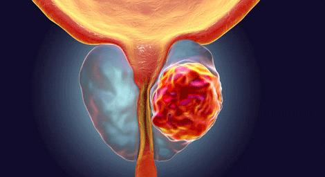 镭223治疗,镭223治疗后的副作用