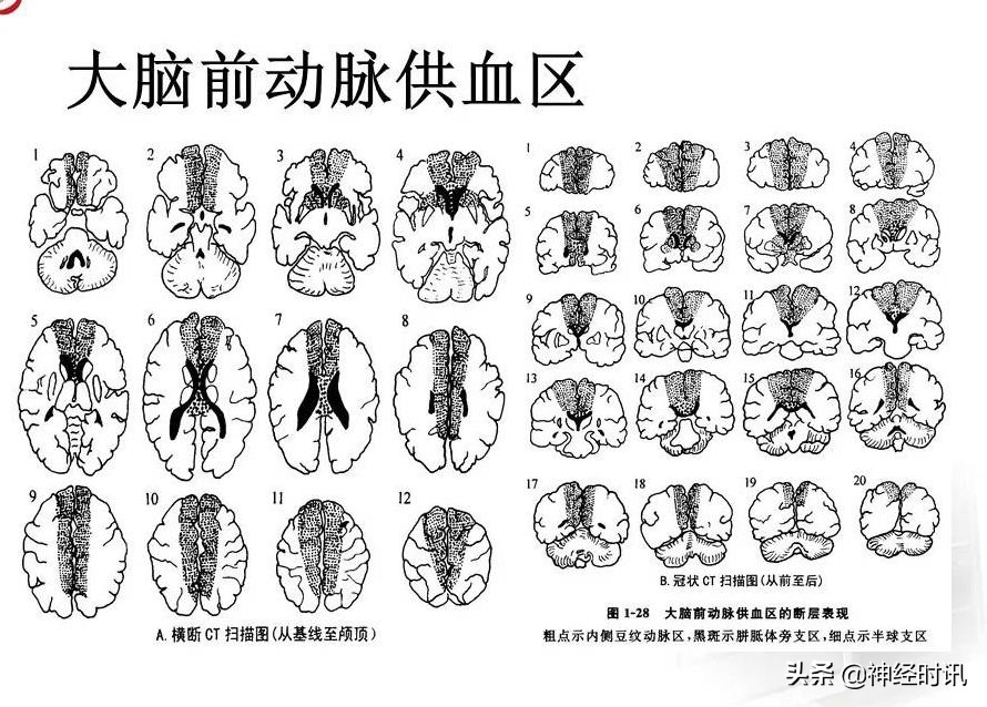 脑动脉解剖学讲解,脑膜中动脉解剖讲解