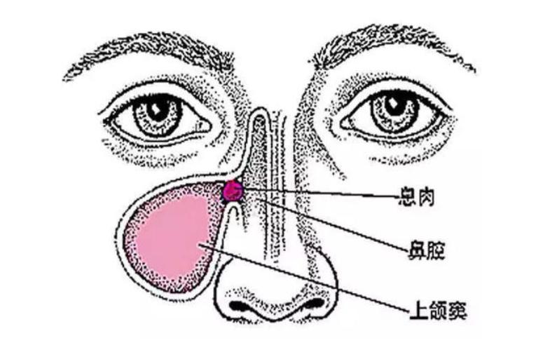 鼻窦炎最严重的症状及表现,耳鼻喉科如何治疗鼻窦炎