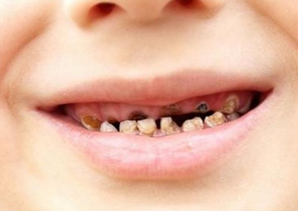 3岁儿童长蛀牙了涂氟可以变好吗,如何预防牙齿蛀牙涂氟