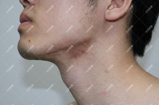 疤康治疤痕疙瘩靠谱吗,瘢痕疙瘩用疤克管用吗