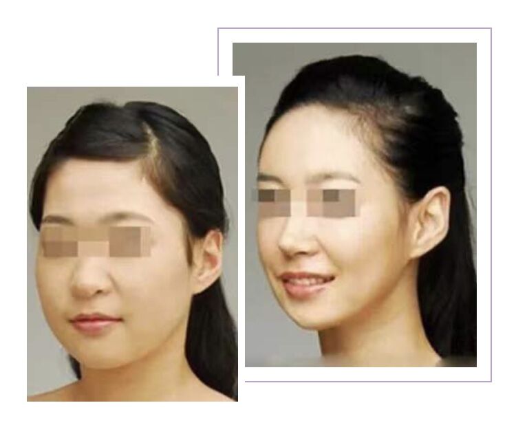 解密瘦脸针的几大常识性问题,关于瘦脸针的几个常识问题