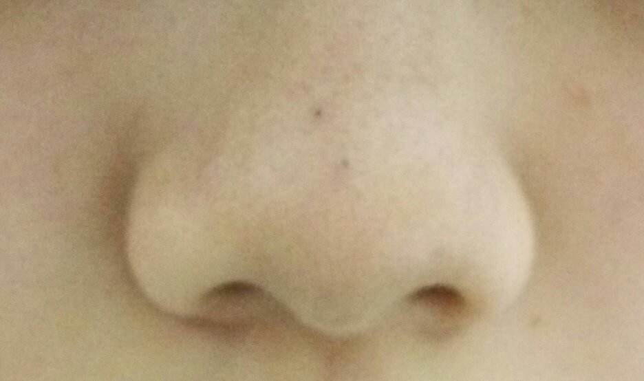 祛痘最有效的方法2天见效,我的祛痘日记