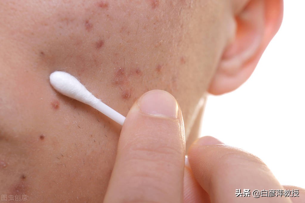 青春痘变疮了要怎么治,青春期痤疮和青春痘的区别
