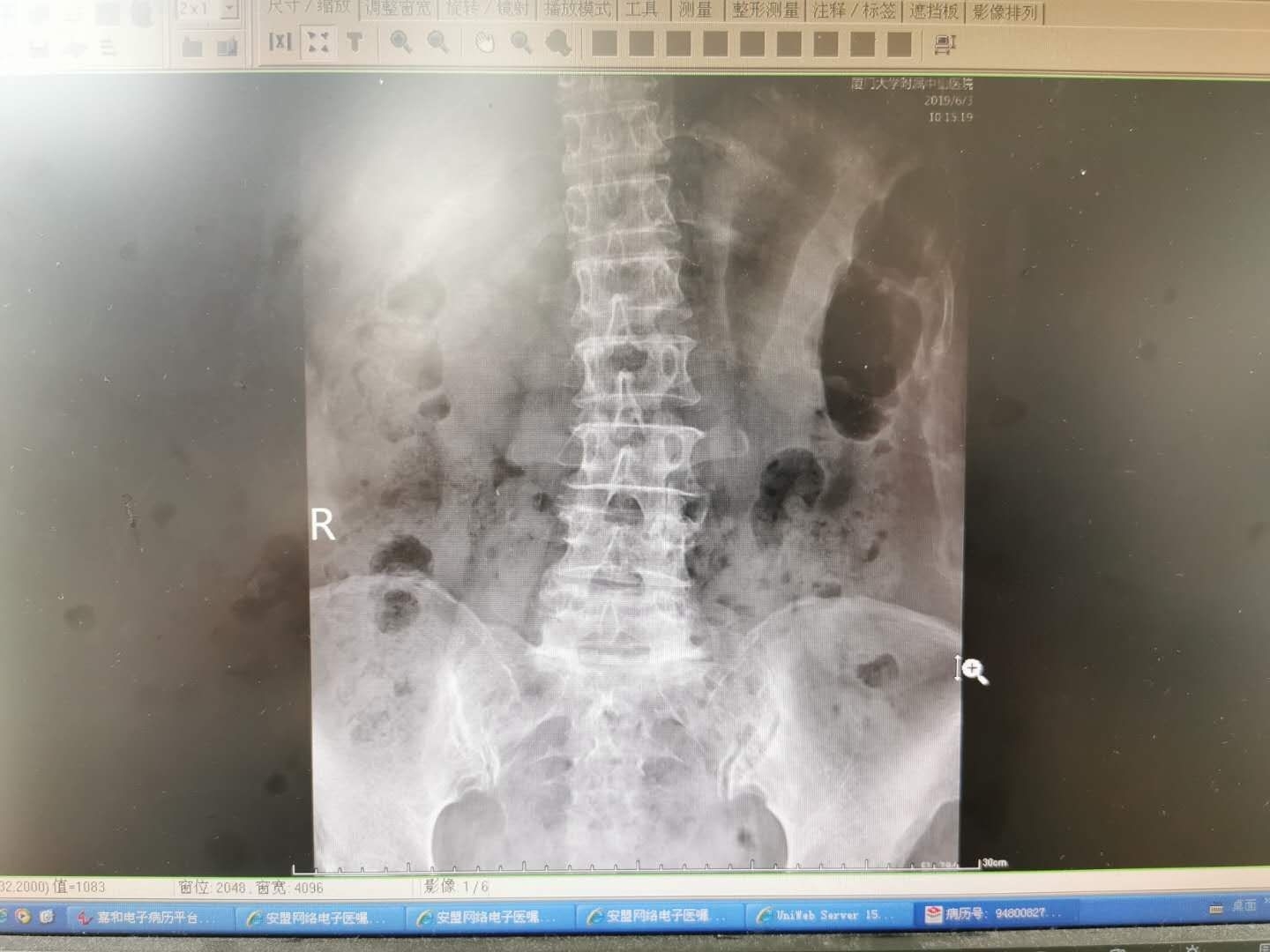 腰痛扎小针刀行吗,腰痛针灸需要吃药嘛