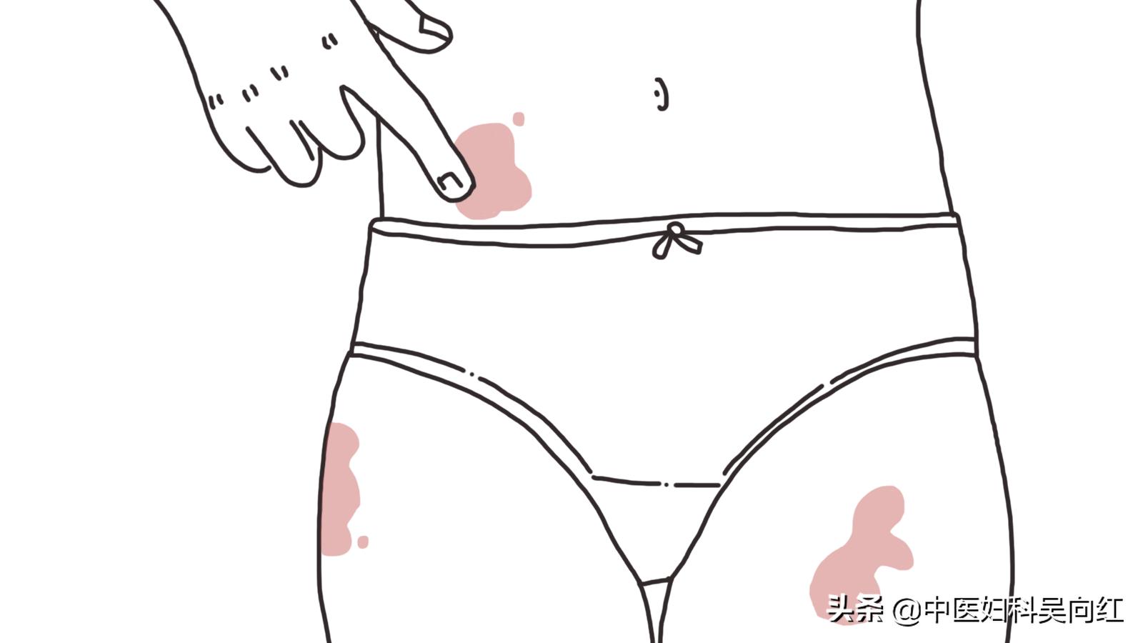 老年性阴道炎的症状和治疗方法,老年性阴道炎有啥症状怎样治