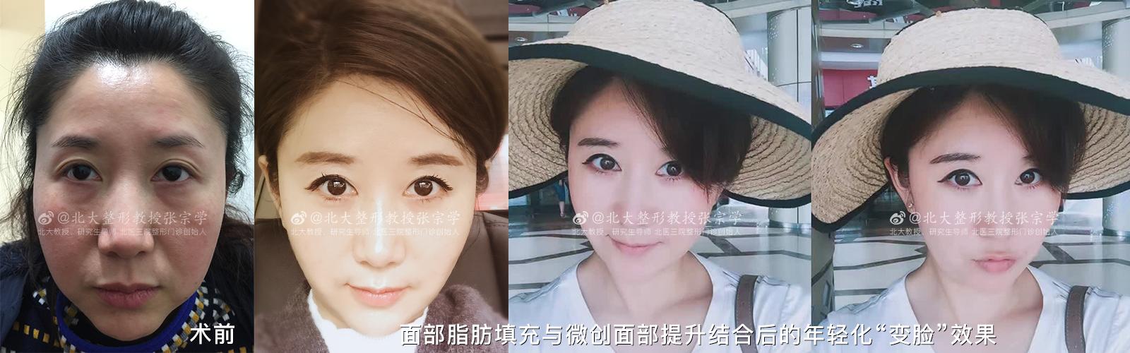 拉皮除皱手术真的有效吗,拉皮除皱手术真的有效果吗