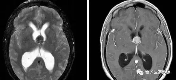 什么引起成人脑室扩大,哪些病可以导致左侧脑室增宽