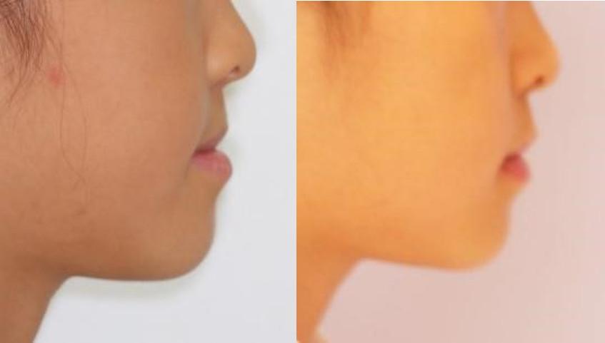 雅悦齿科,做了牙齿矫正容易得牙龈萎缩吗