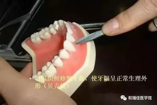 松牙固定需要什么条件,钢丝松牙固定操作流程