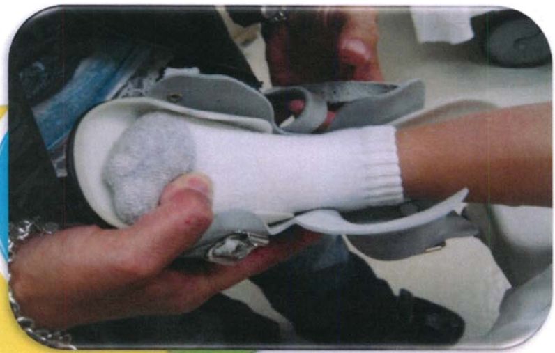 马蹄足畸形矫正案例,足踝部畸形矫正