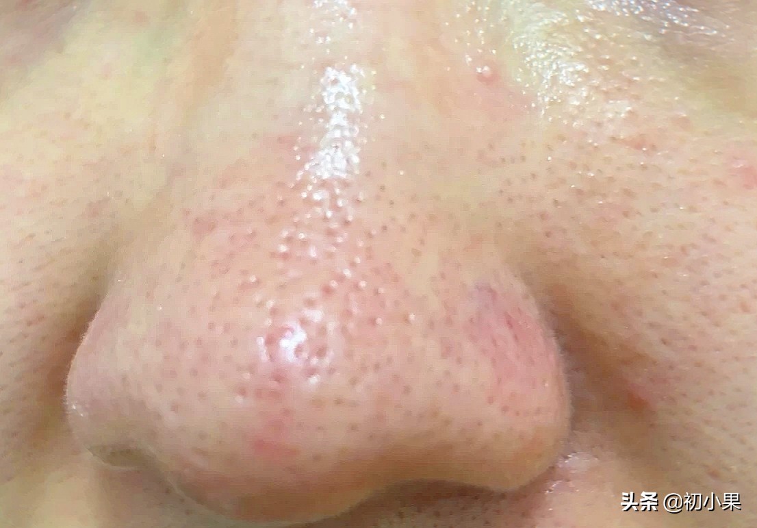 鼻子上的黑头怎么去除,鼻子上的黑头怎么去除儿童