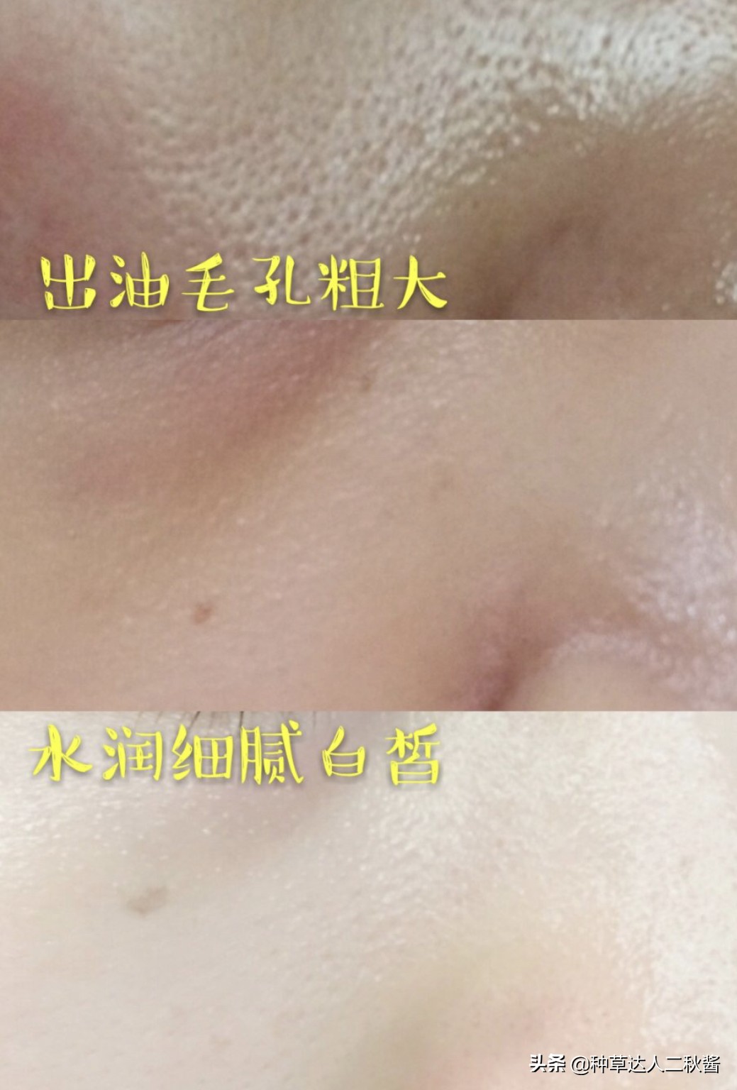 男士毛孔粗大出油黑头用什么护肤,毛孔粗大皮肤干如何正确护肤